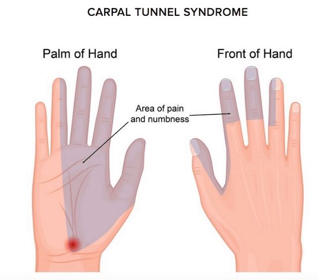 When Carpal Tunnel Syndrome is the Wrong Diagnosis